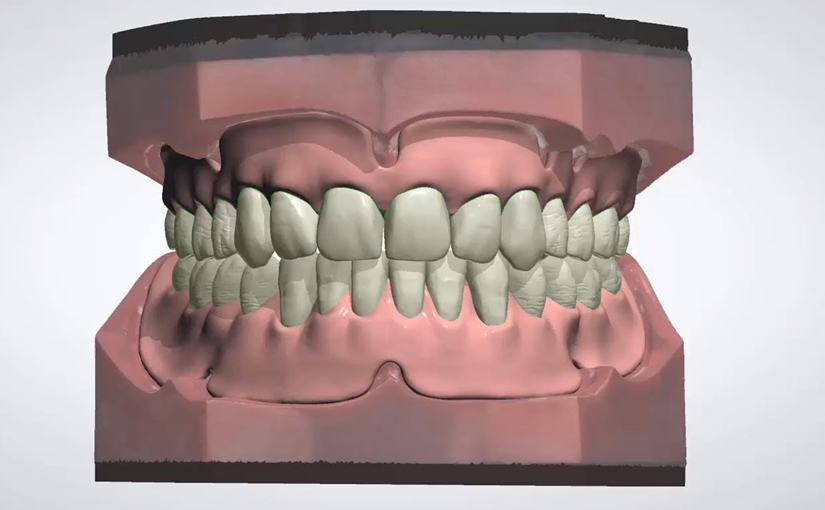 Digital Denture