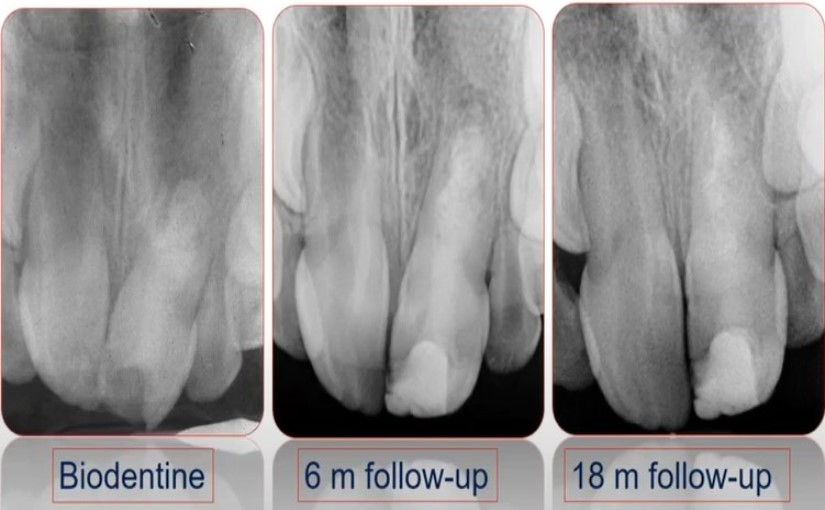 Preserving-Pulp-with-Tricalcium-Silicates